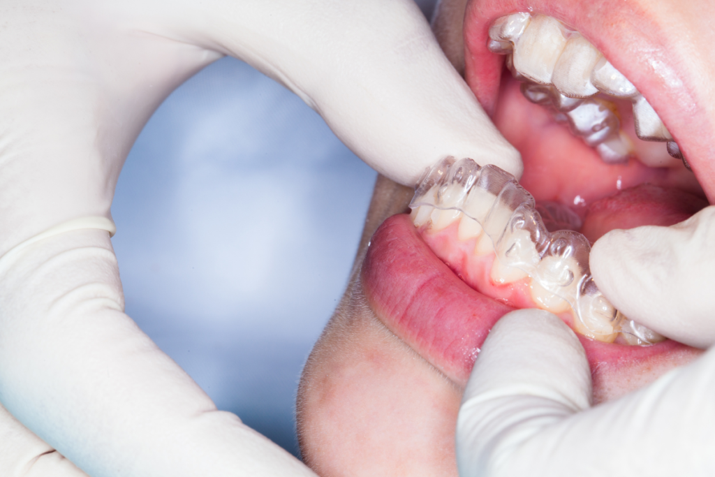Nakładki ortodontyczne